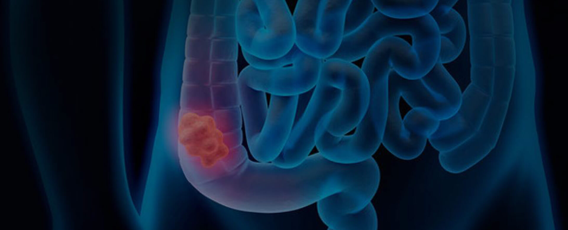 Tumore del colon-retto: nel microbiota intestinale la nuova arma per combatterlo