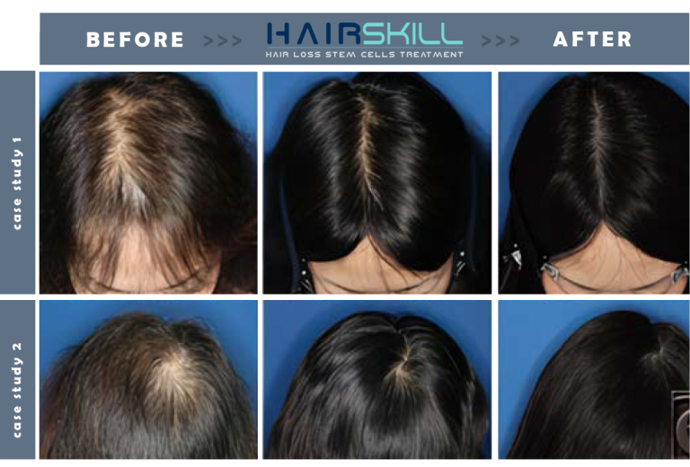 Stem Cell Treatment for Hair Loss Stem Cell Hair Growth